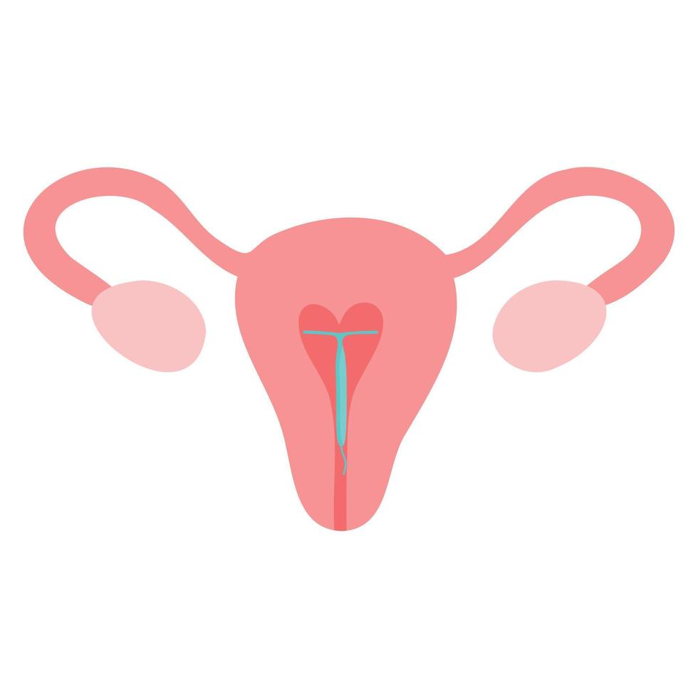 diu hormonal. icono de estilo plano de color del dispositivo intrauterino de cobre. mujeres métodos anticonceptivos de control de la natalidad. anticoncepción femenina. vector