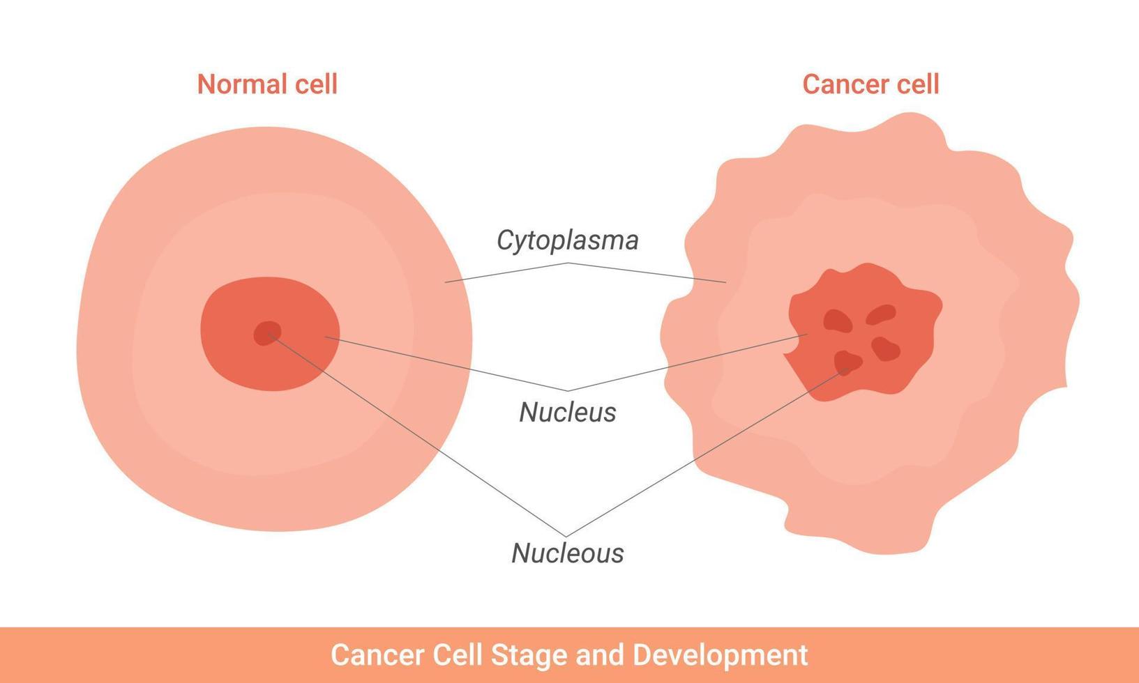 ilustración de etapa y desarrollo de células cancerosas vector