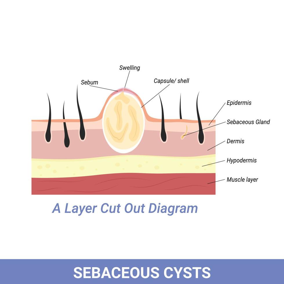 Sebaceous Cyst or other skin and follicle problems illustration vector