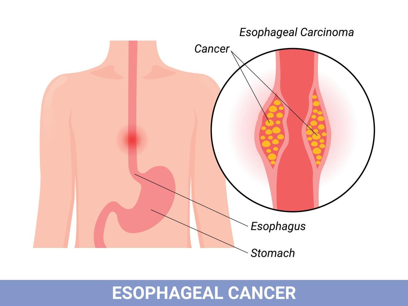 Medical illustration of the symptoms of esophageal carcinoma vector