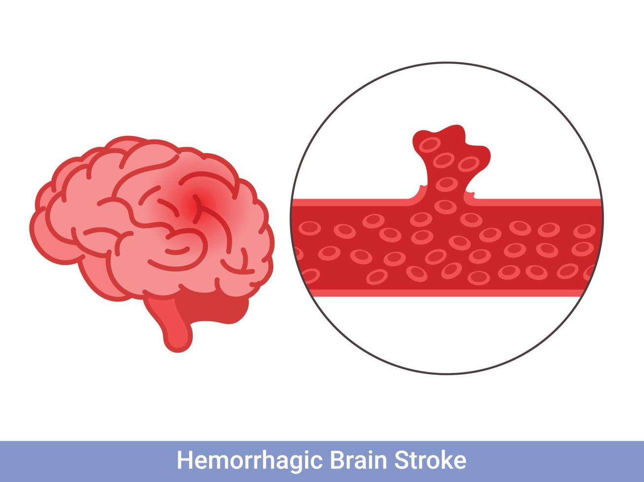 Hemorrhagic brain stroke concept. Apoplexy, cerebral hemorrhage, headache problem vector