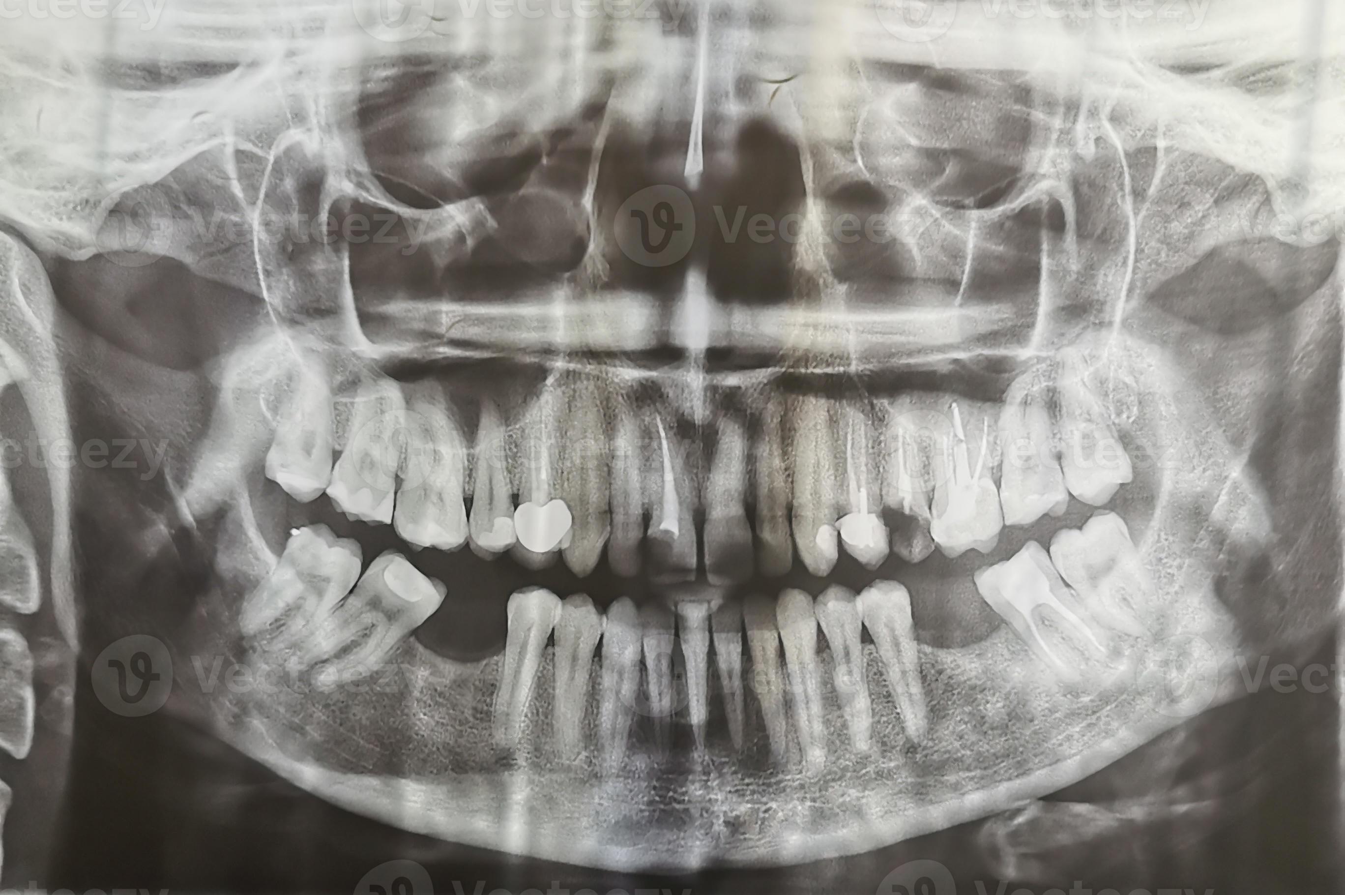 Dental radiography. Digital xray teeth scan of adult female. Human