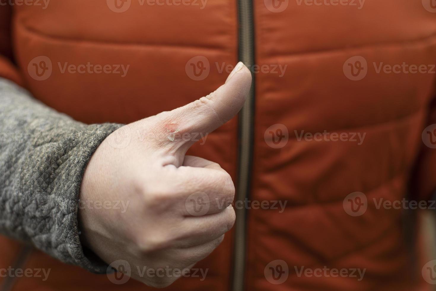 Man's hand with wound on his skin. Damaged finger. photo