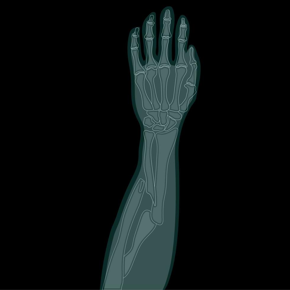 Ilustración de vector de rayos x de brazo roto