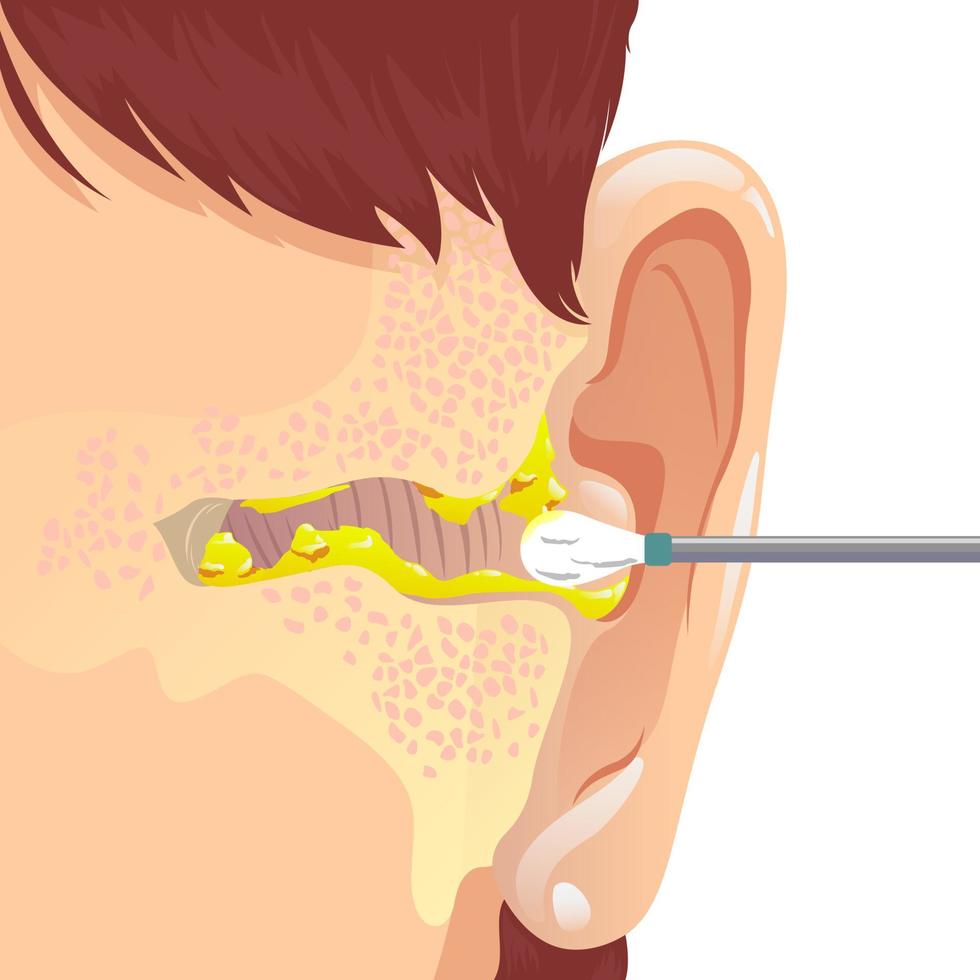 oreja sucia con cerumen vector