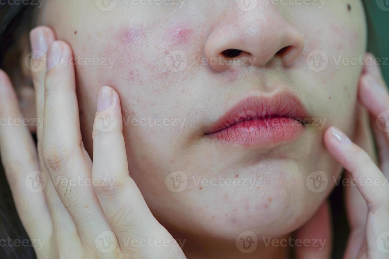 grano de acné y cicatriz en la cara de la piel, trastornos de las glándulas sebáceas, problema de belleza del cuidado de la piel de las adolescentes. foto