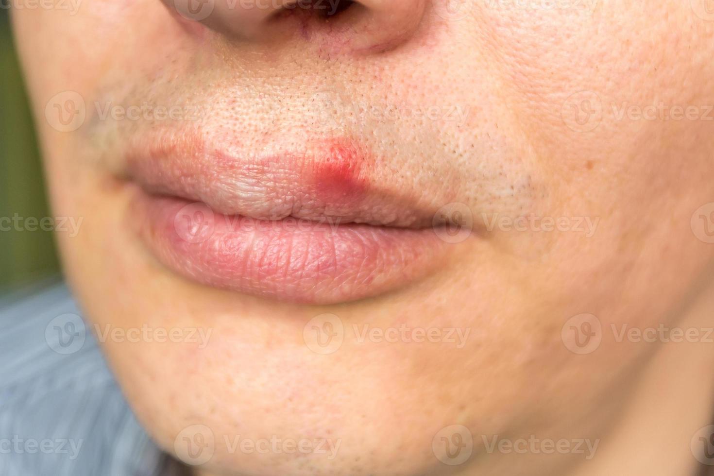 red inflammation and herpes zoster virus on upper male lip 10335043 Stock Photo at Vecteezy