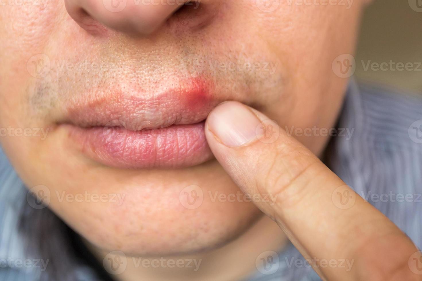 red inflammation and herpes zoster virus on upper male lip photo