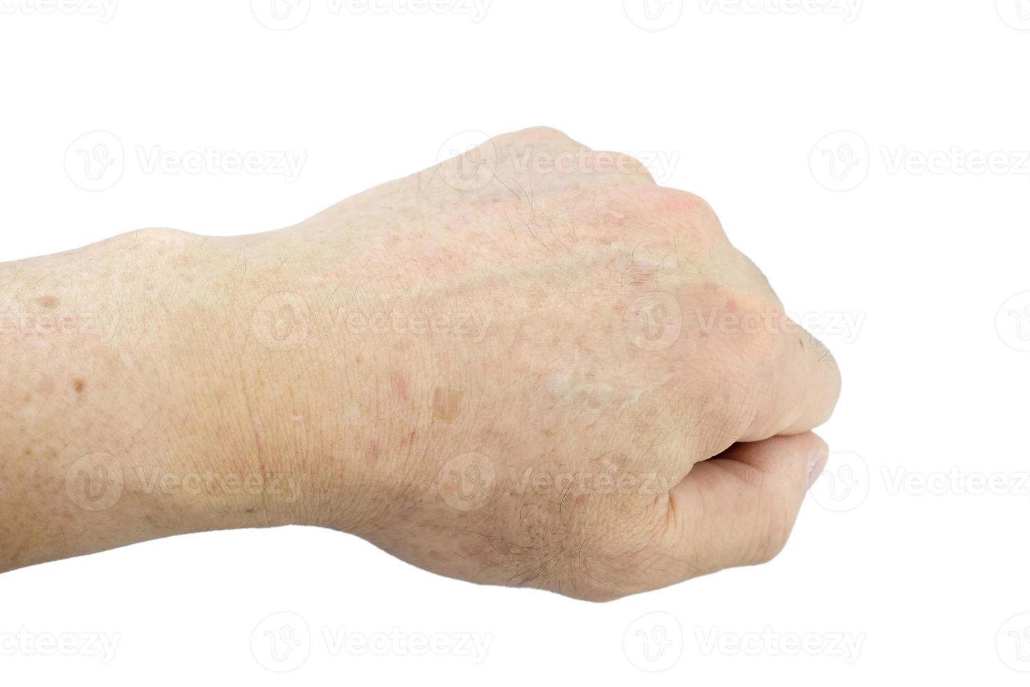 Age spots on hands of man. Liver spots, Brown, black or sun spots, Senile lentigo, Solar lentigines. Premature aging skin, Dermatology, Symptomatology Elderly Person. Isolated on white background. photo