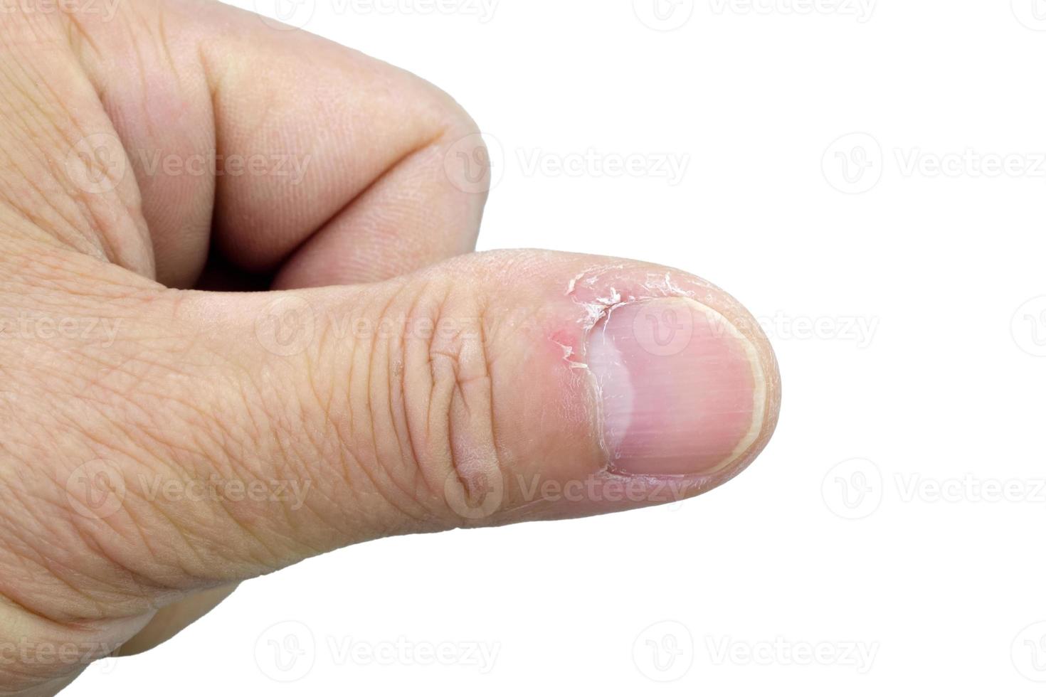 Close-up of thumb and nail with dry skin, torn and flaking off, cracked skin on cuticles, dry brittle nails. Broken fingernails inflammation. Chipped nails. Isolated on white background. photo