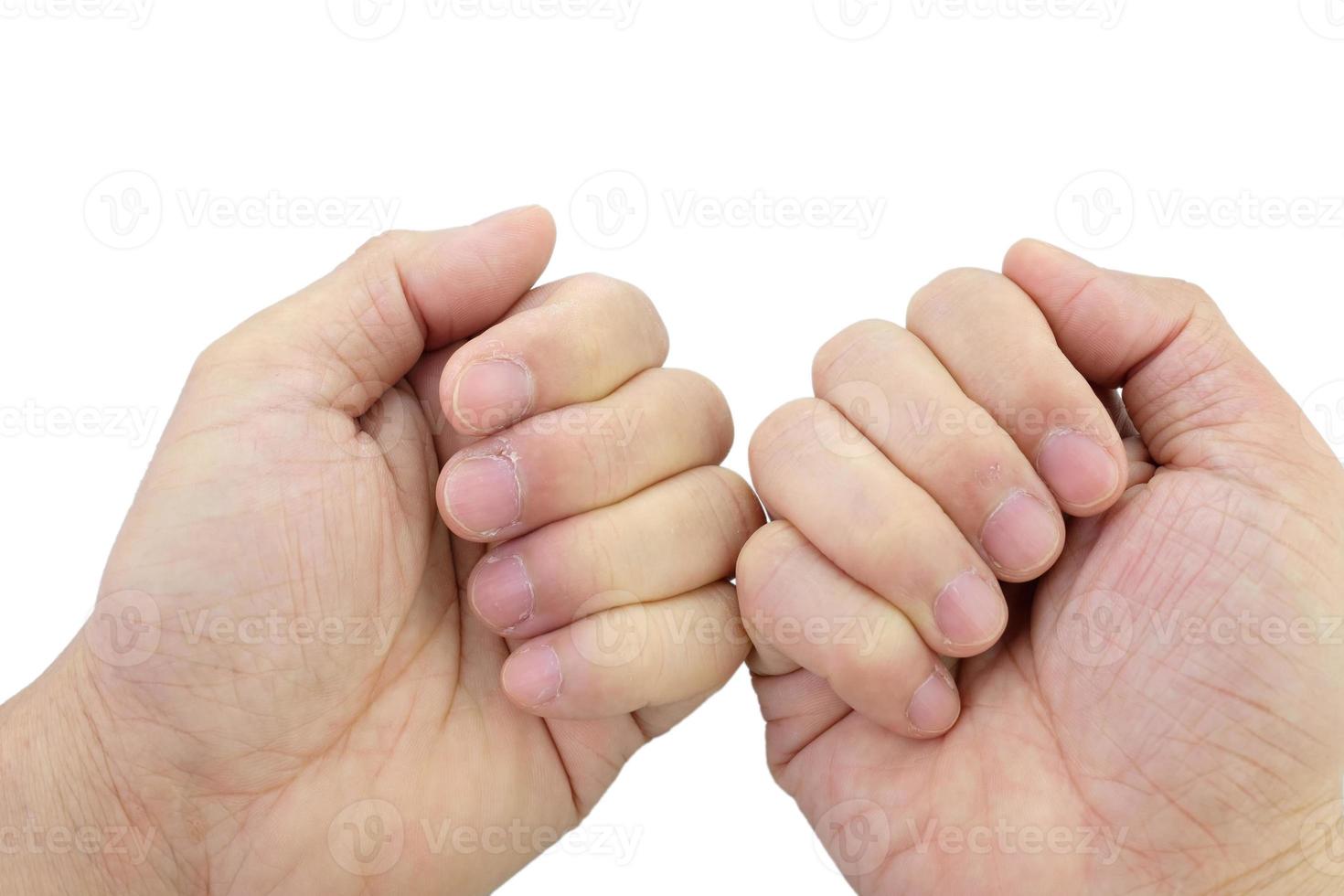 Close-up of fingers and nails with dry skin, torn and flaking off, cracked skin on cuticles, dry brittle nails. Broken fingernails inflammation. Chipped nails. Isolated on white background. photo