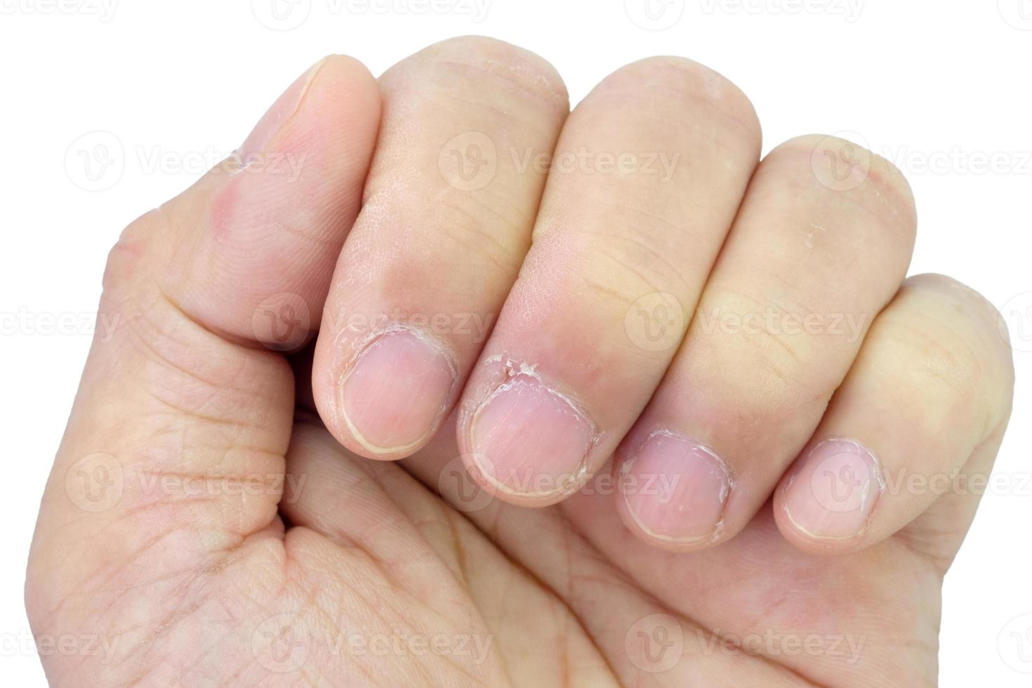 Close-up of fingers and nails with dry skin, torn and flaking off, cracked skin on cuticles, dry brittle nails. Broken fingernails inflammation. Chipped nails. Isolated on white background. photo