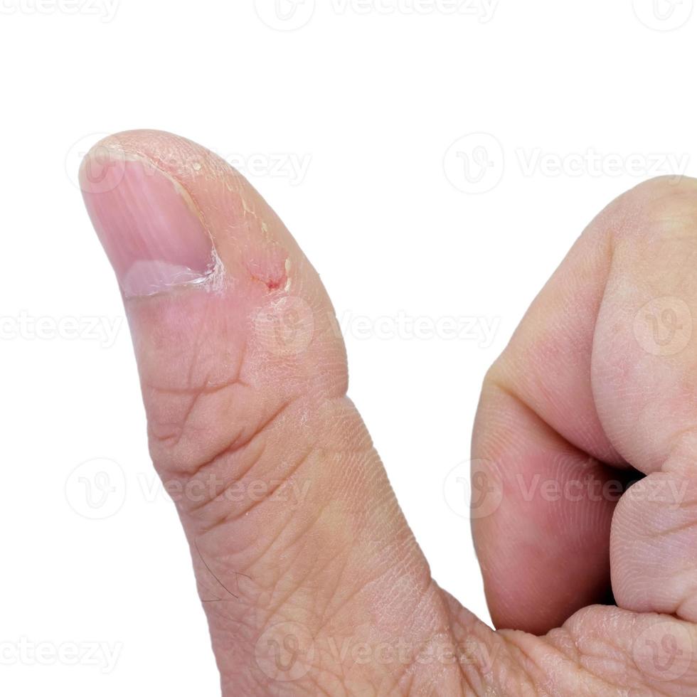 Close-up of thumb and nail with dry skin, torn and flaking off, cracked skin on cuticles, dry brittle nails. Broken fingernails inflammation. Chipped nails. Isolated on white background. photo