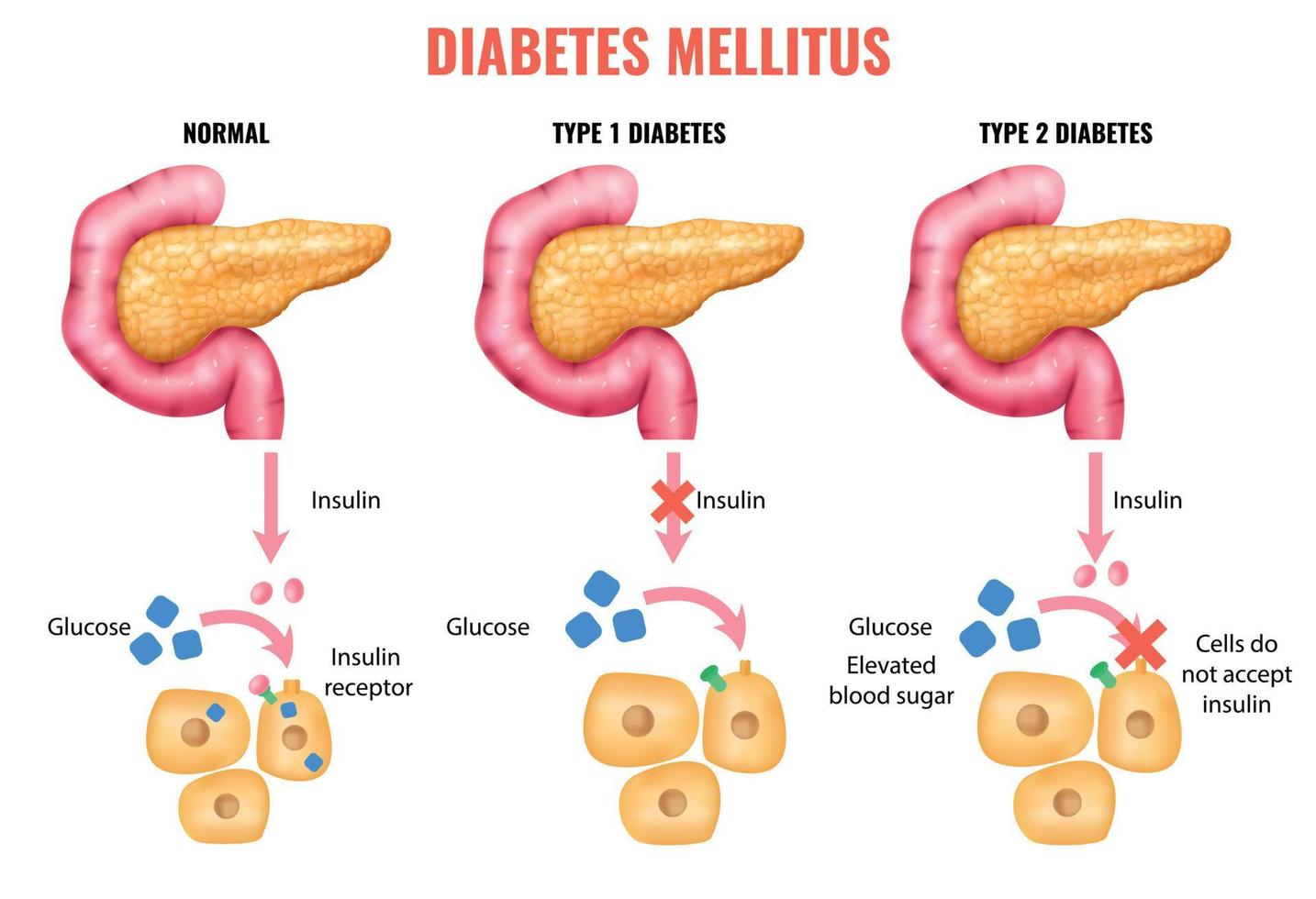 infografías realistas de diabetes mellitus vector