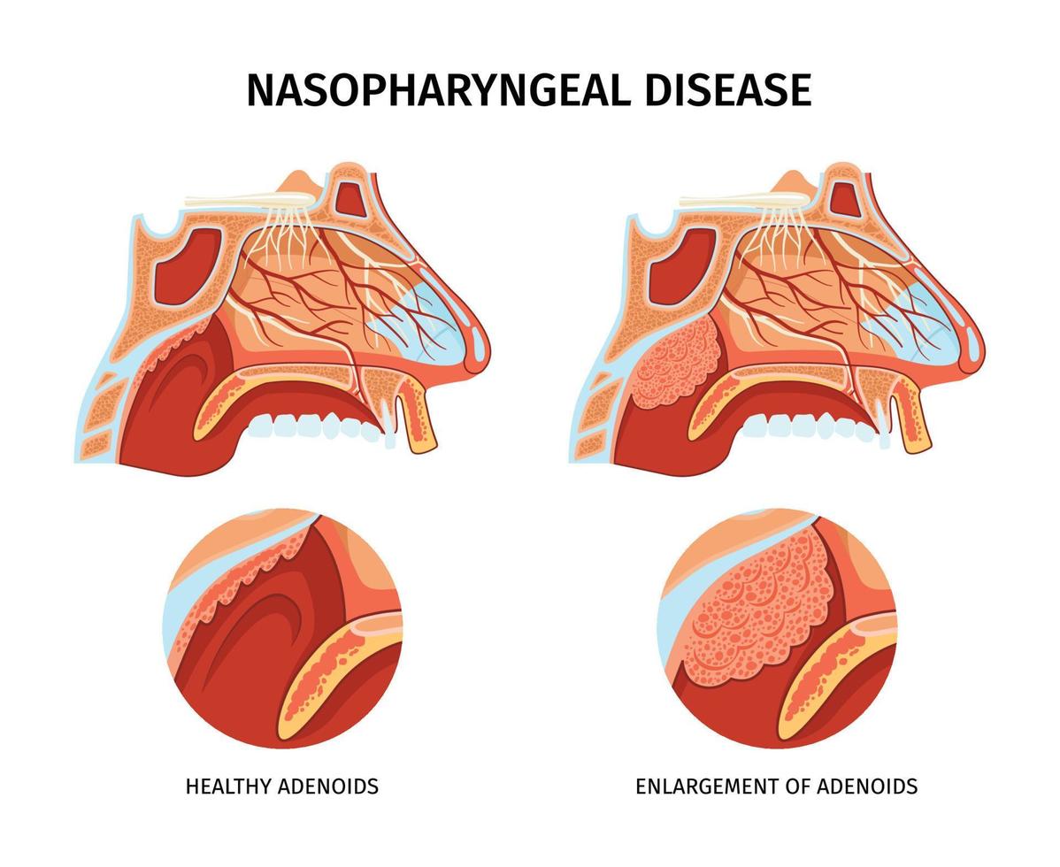 cartel de enfermedad nasofaríngea vector