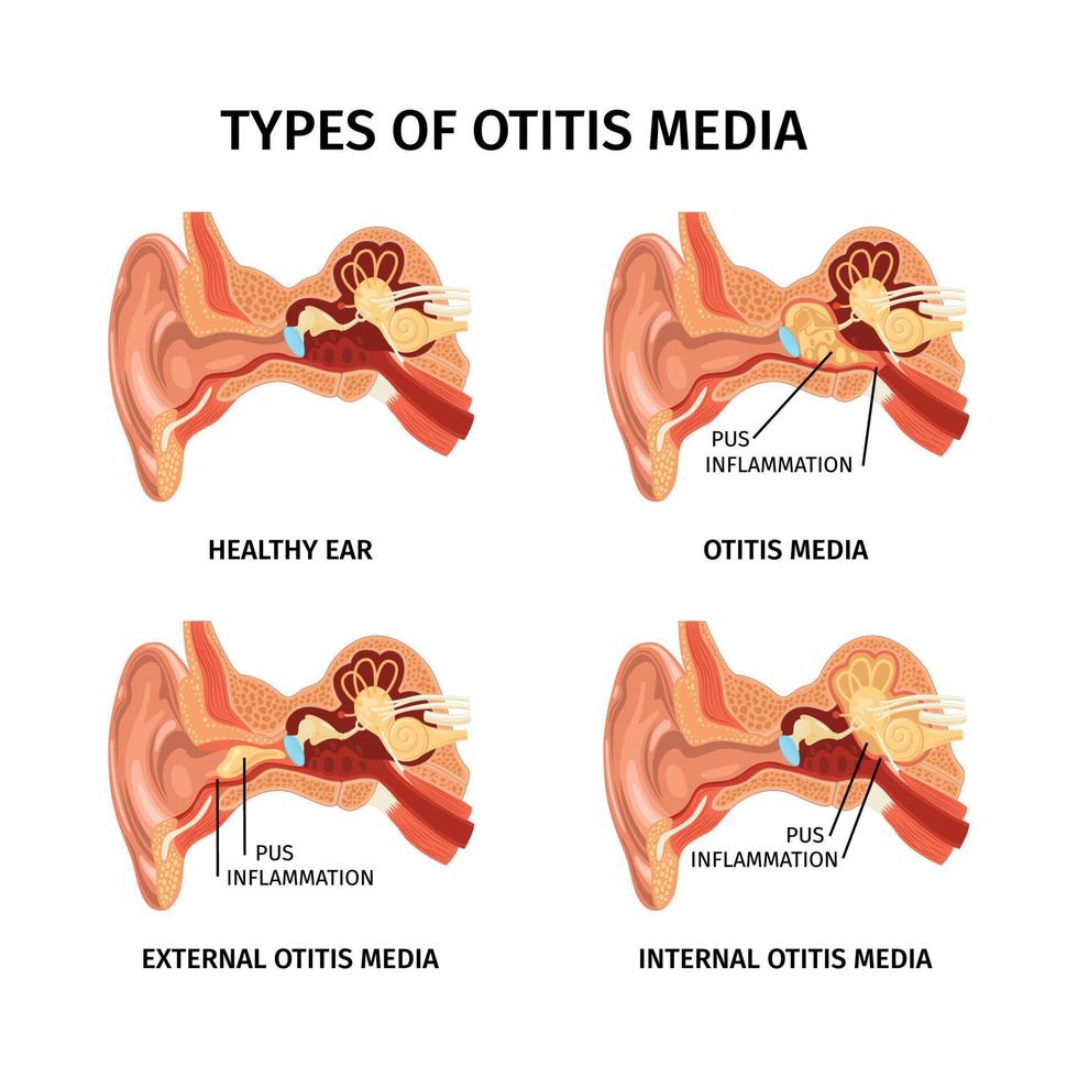 conjunto de otitis de oído realista vector