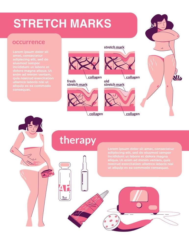 Female Stretch Marks Infographics vector