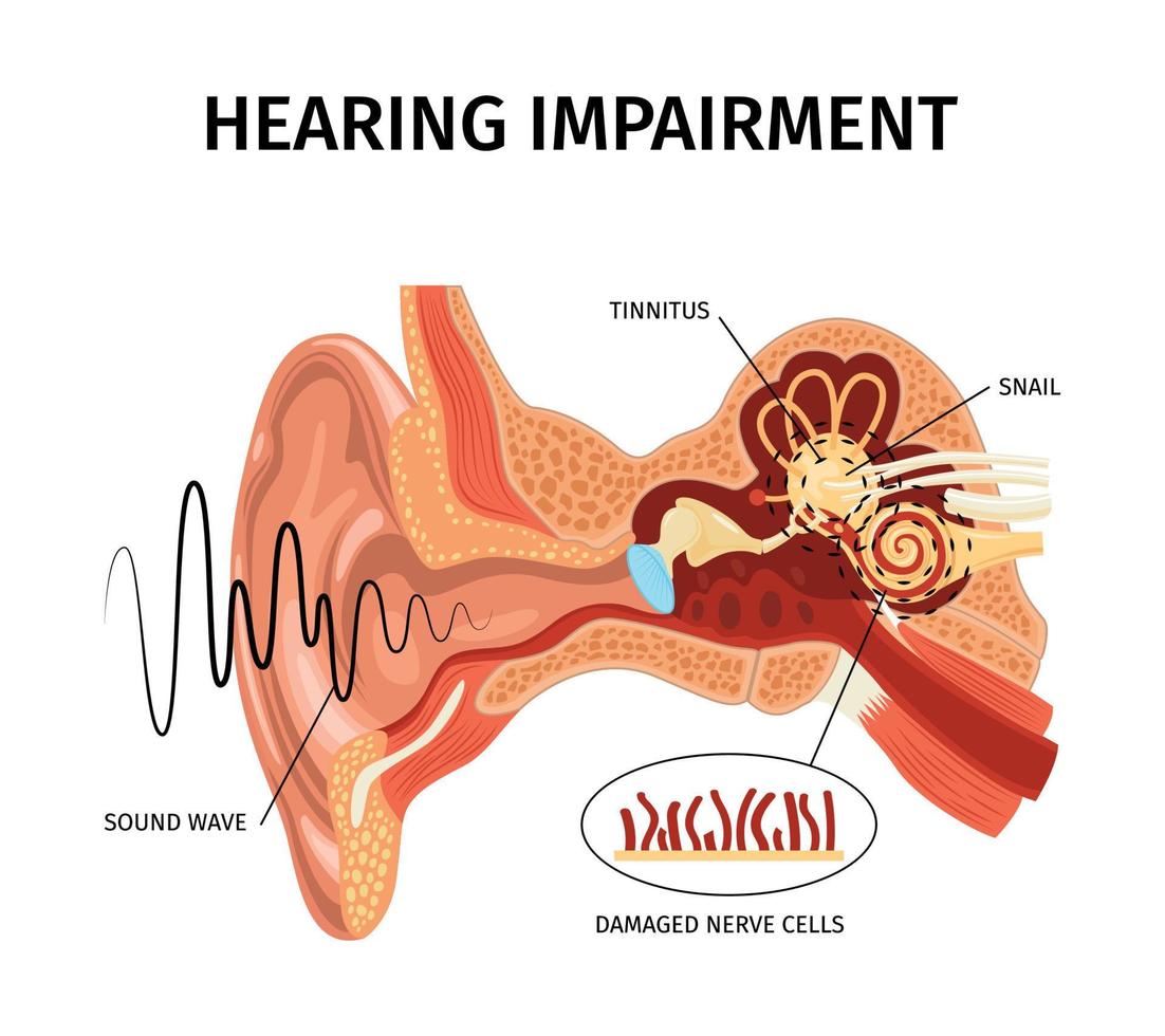 Hearing Impairment Anatomic Composition vector