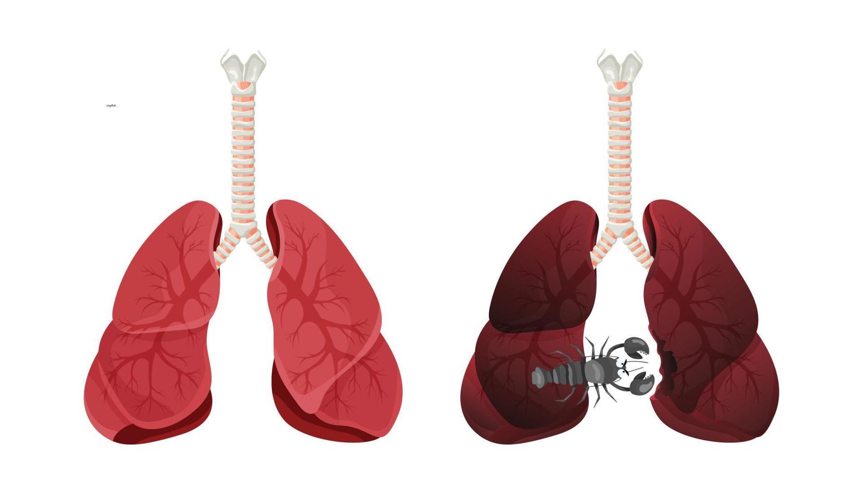 Illustration of lung smoker, lung cancer disease. The concept of stop smoking. Vector illustration.