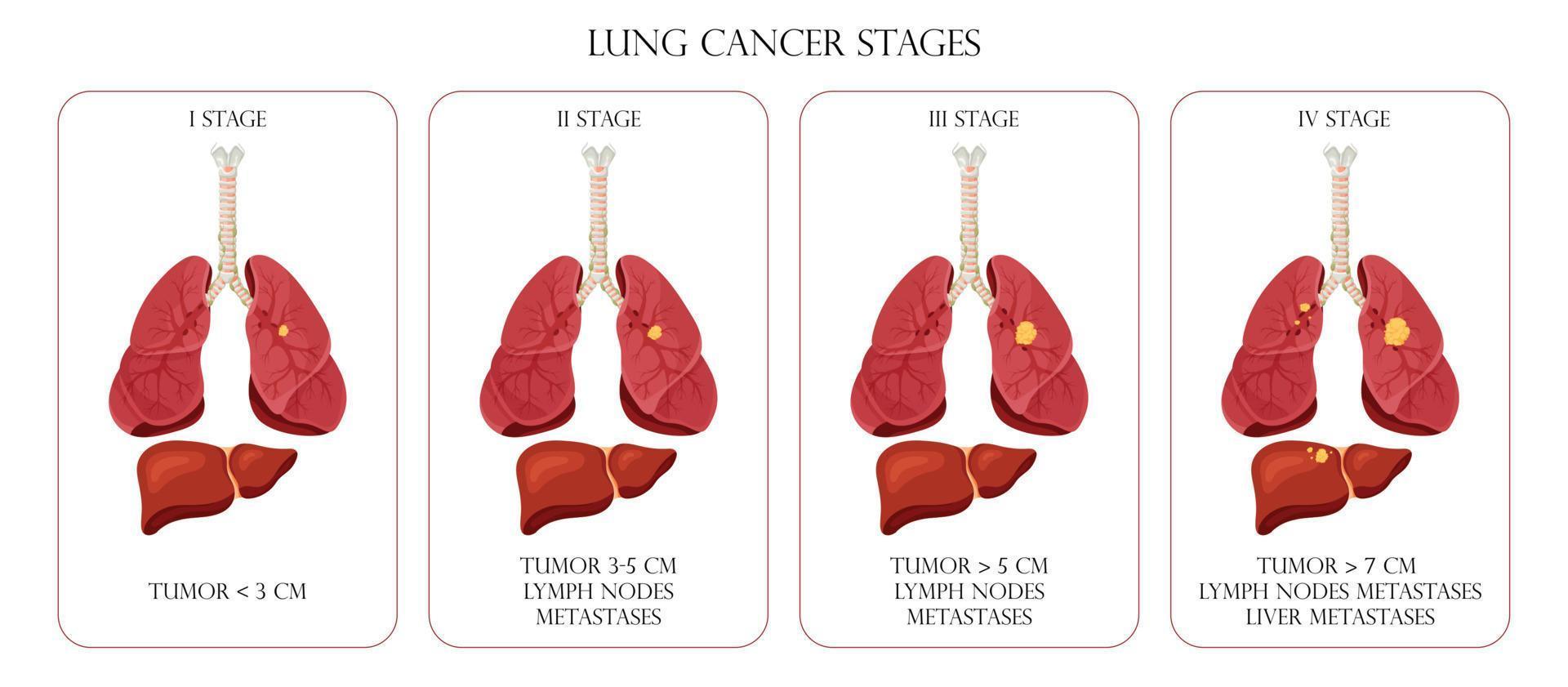 Lung cancer stages. Concept diseases human internal organs. Cartoon style, vector illustration.