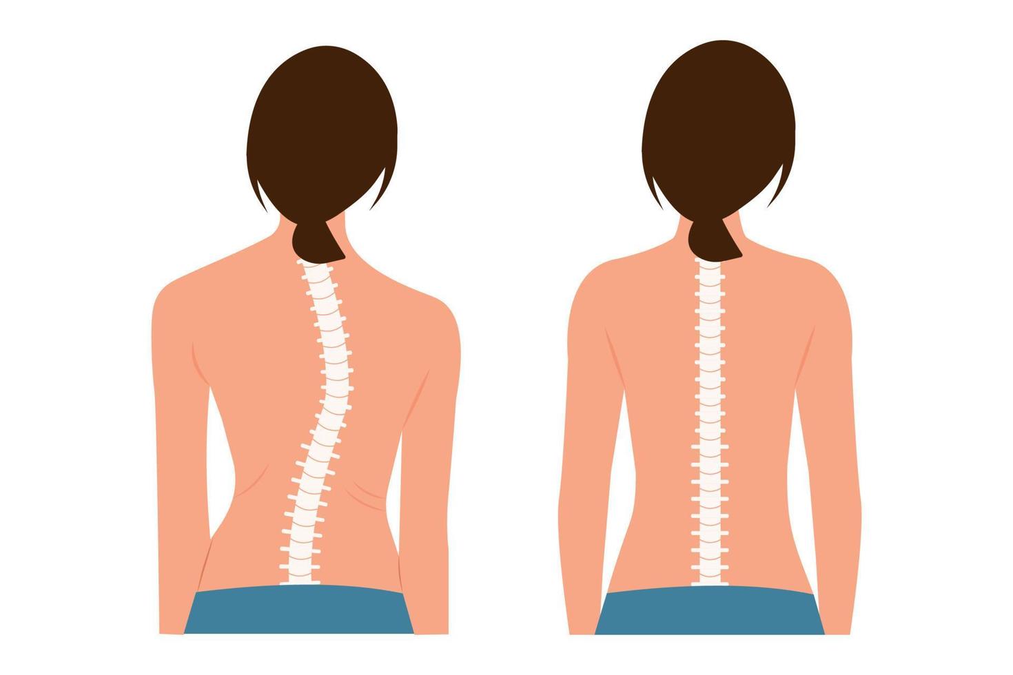 buena postura y mala postura. quiropráctica antes después de la imagen. escoliosis.cuerpo y columna vertebral de la mujer. vector