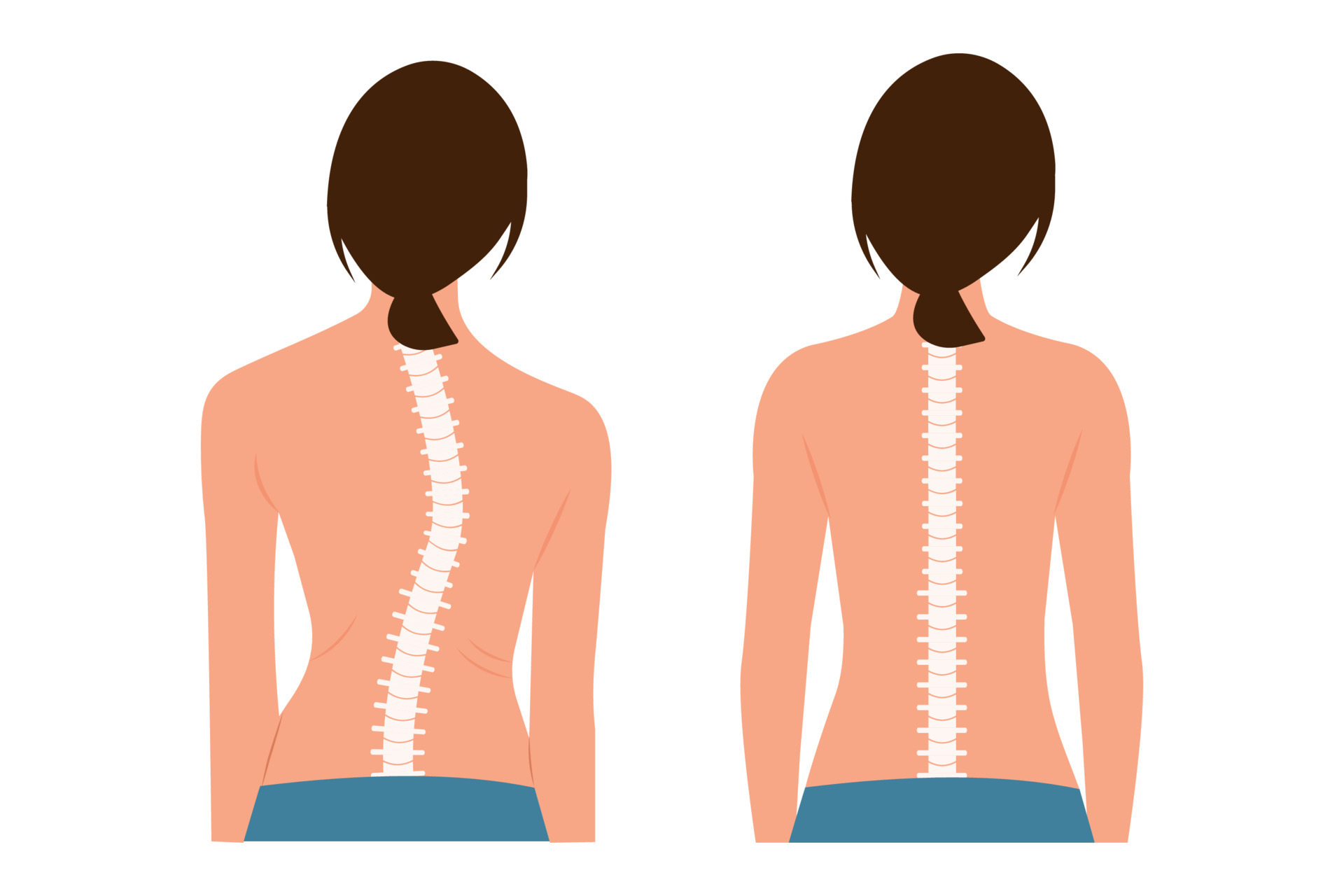 Good posture and bad posture. Chiropractic before after image