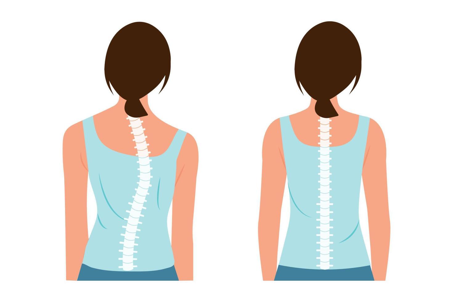 Good posture and bad posture. Chiropractic before after image. Scoliosis.Woman's body and backbone. vector