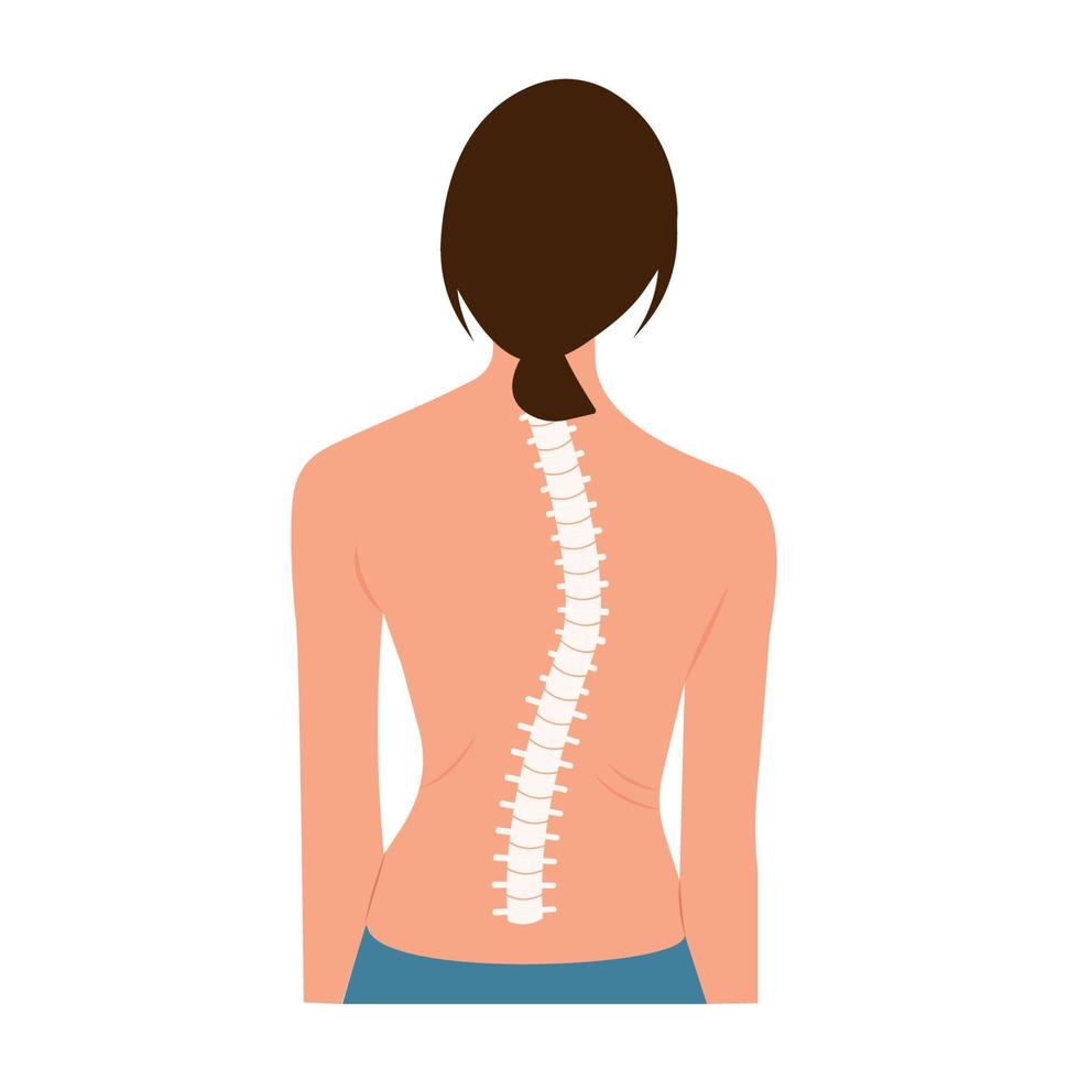 anatomía de la curva de la columna vertebral de la escoliosis, corrección de la postura. tratamiento quiropráctico. ilustración vectorial de la mujer de vista trasera que representa la escoliosis y la escala de curvatura vector