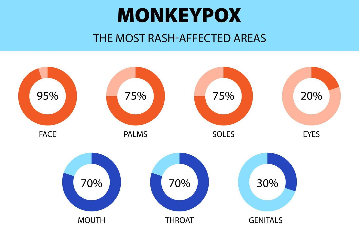 Monkeypox virus infographic. Diagram of the most rash affected areas. New outbreak cases in Europe and USA. vector