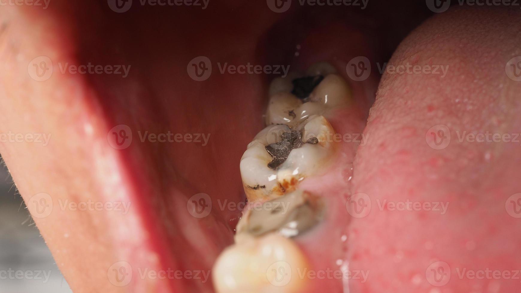 Tratamiento de conductos radiculares de dientes cariados. Diente o caries dental del molar inferior. foto