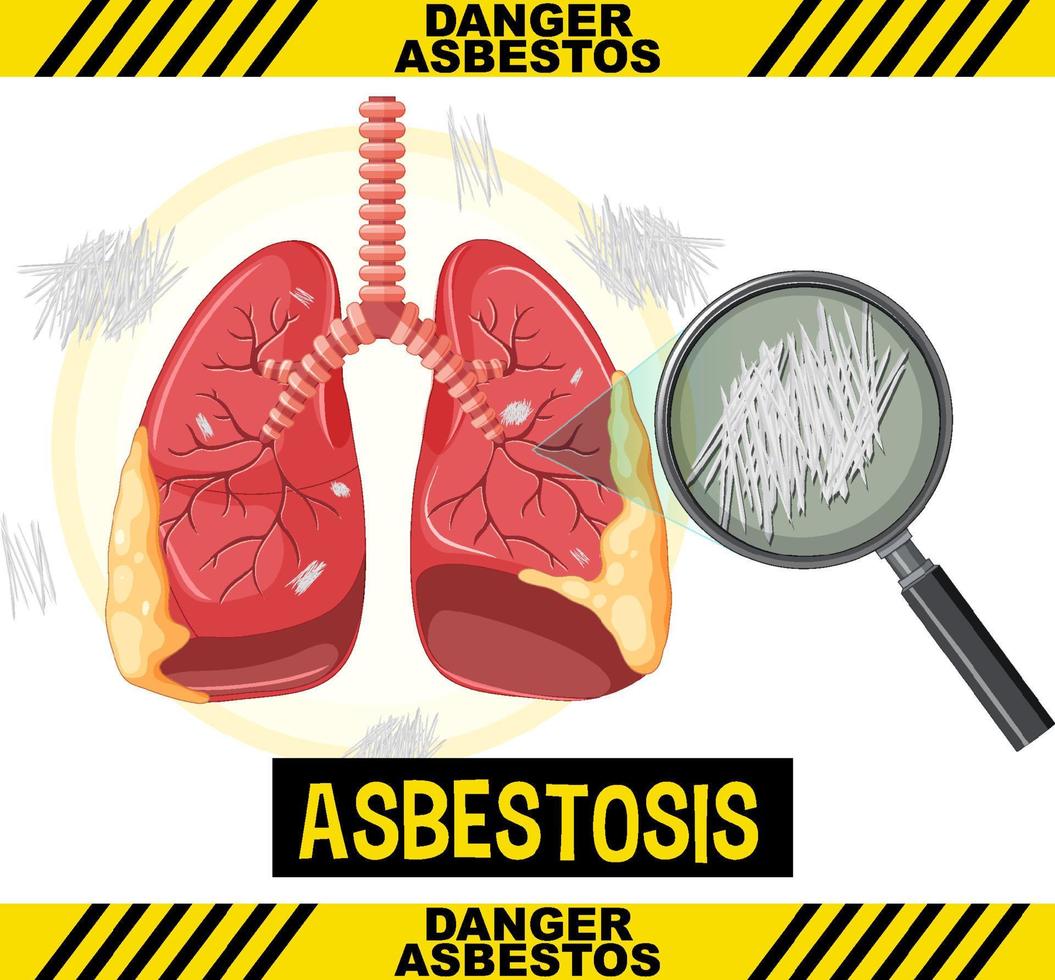 Diagram showing asbestosis in lungs vector