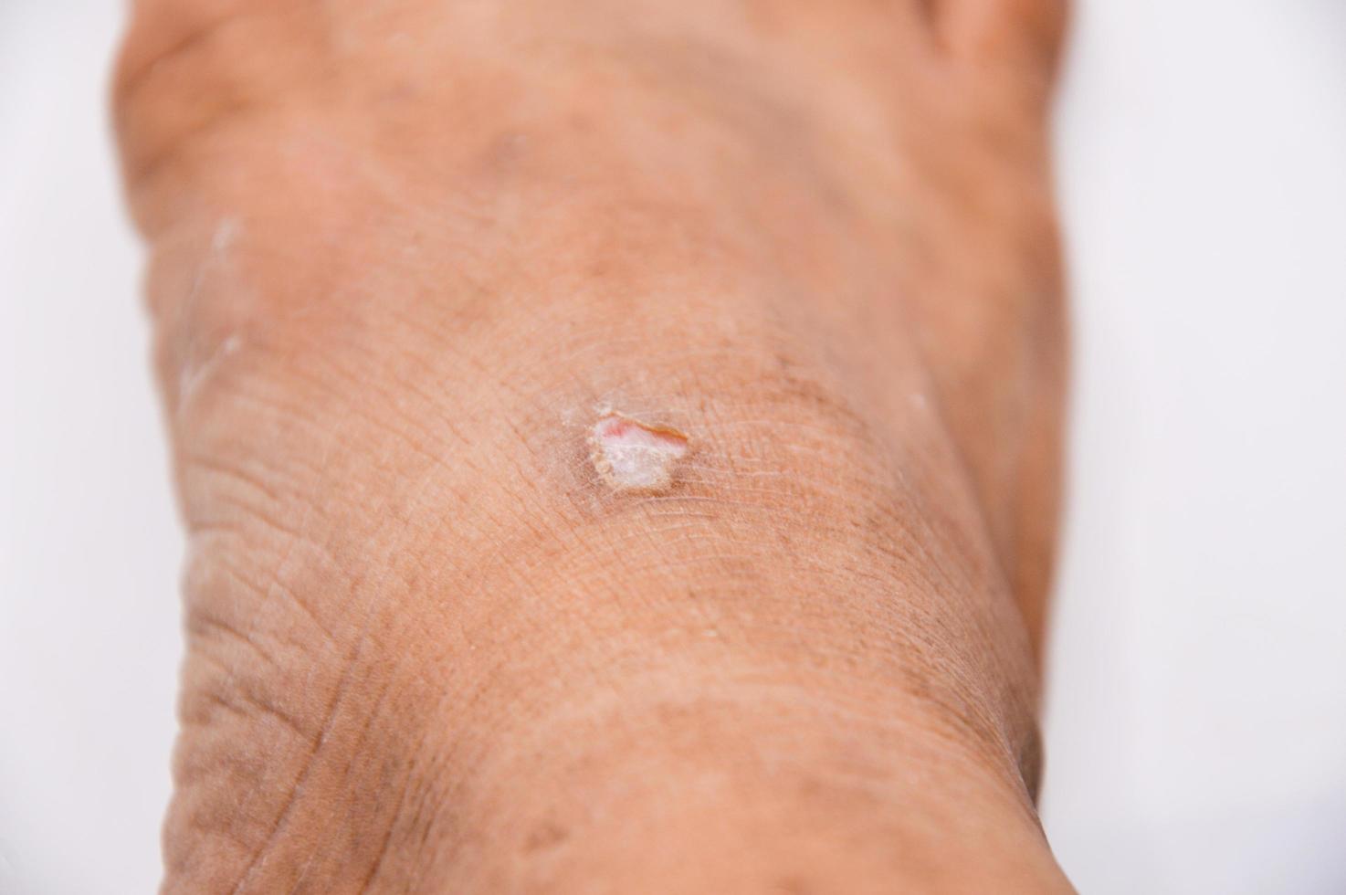 úlcera de pie roja inflamación de la herida curación del concepto de fondo blanco foto