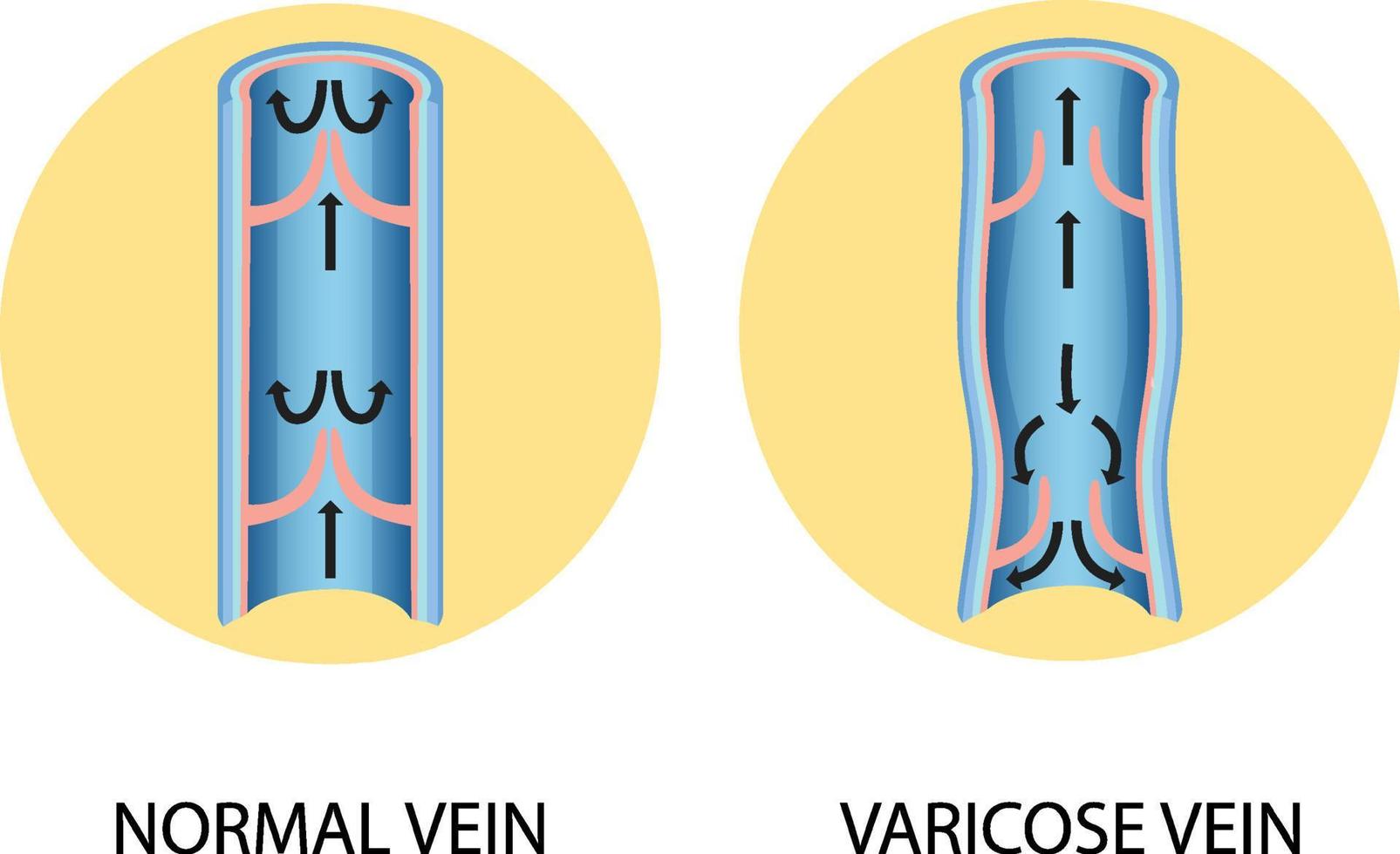 A comparison of normal vein with varicose vein vector