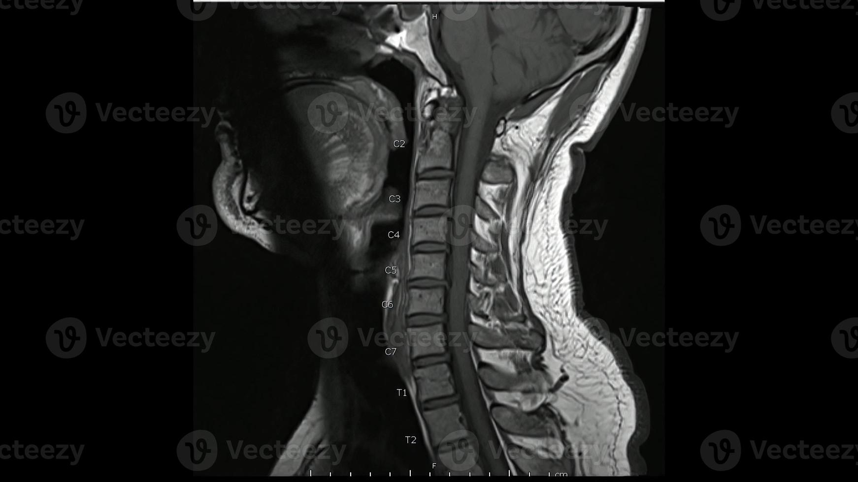 Magnetic Resonance images of Cervical spine sagittal T1-weighted images ,MRI Cervical spine, showing mild disc disease. photo