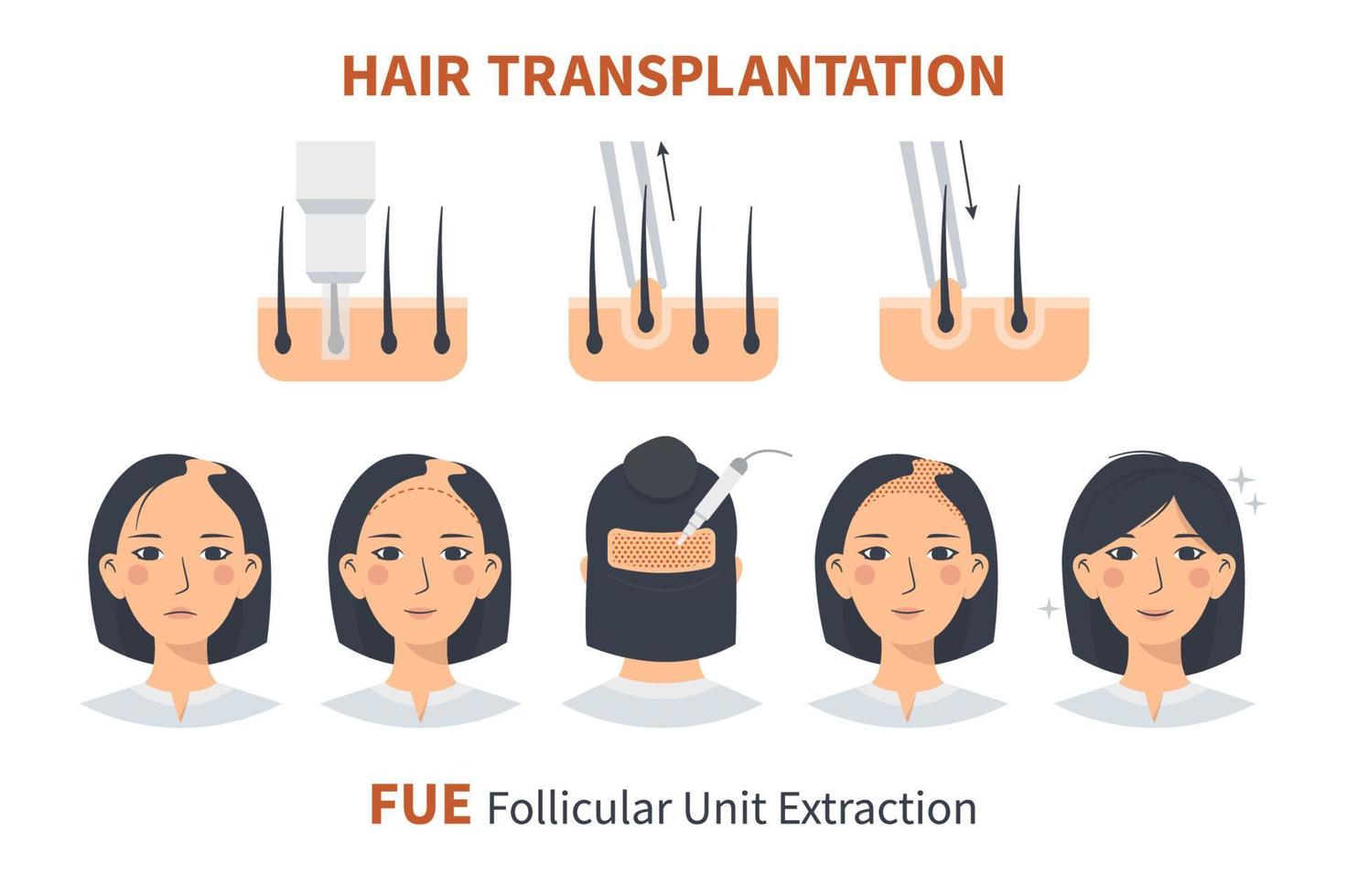 Stages of woman hair transplantation FUE Follicular Unit Extraction. Treatment of baldness, alopecia and hair loss. Vector medical infographics, a female head scalp. Strip, graft machine.