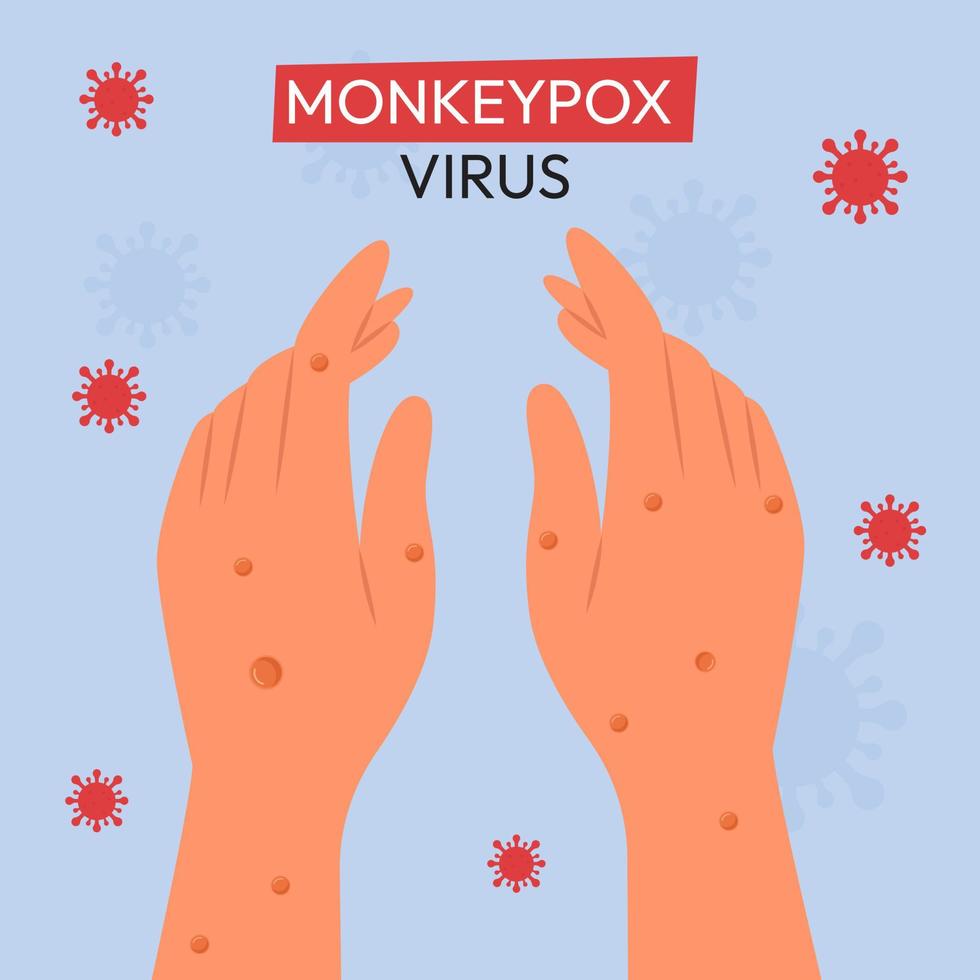 Monkeypox outbreak. Monkeypox are shown on the patient's hand. Flat vector illustration for informing people about an infectious disease.