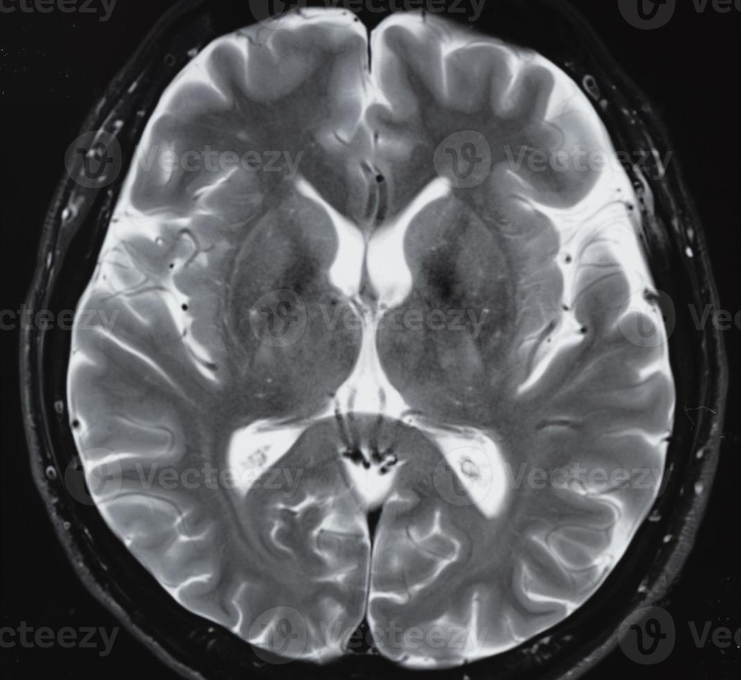 resonancia magnética de la anatomía normal del cerebro humano foto