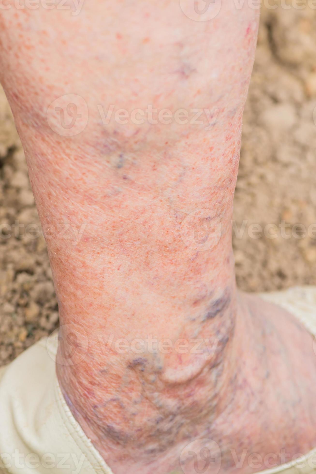 leg of old woman with varicose veins 10602022 Stock Photo at Vecteezy