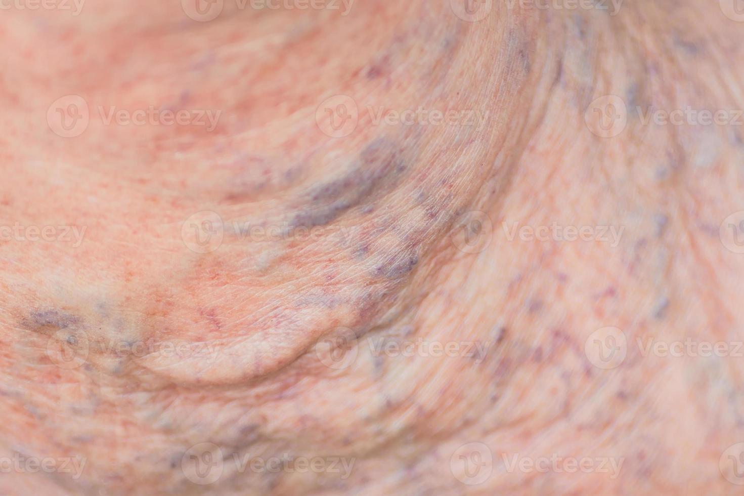 close up of varicose veins on female leg photo