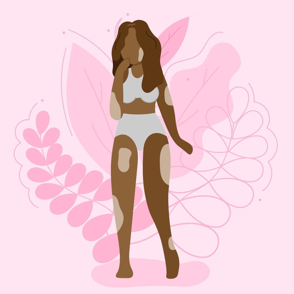 Vector illustration on the theme of body positivity. A girl with vitiligo, with long wavy hair on a background of beautiful leaves. Flat style