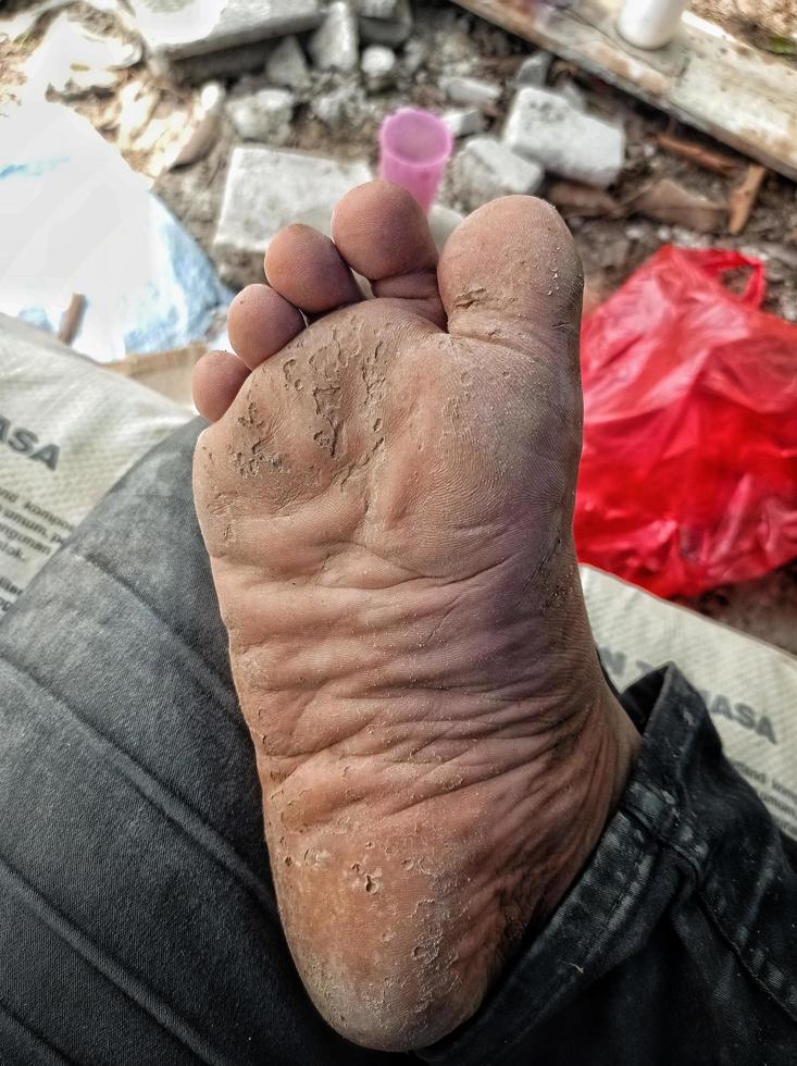 vista cercana de una enfermedad fúngica. pies de personas con piel seca. hombre descalzo con piernas poco atractivas y poco saludables. tratamientos de salón y procedimientos de la piel. foto