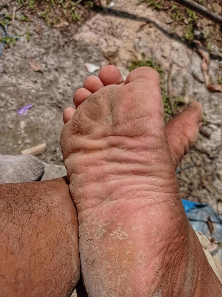 Close-up view of a fungal disease. Feet of people with dry skin. Barefoot man with unattractive and unhealthy legs. Salon treatments and skin procedures. photo