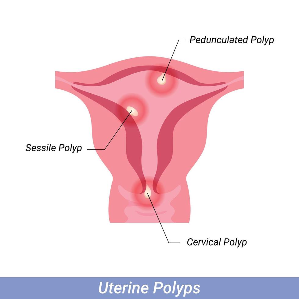 Polyps in the uterus Female reproductive system. Human anatomy internal organs vector