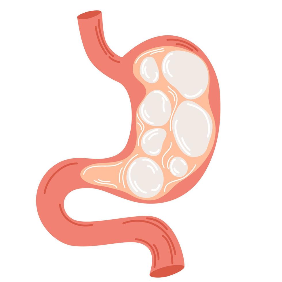 Bloating. Heaviness in stomach. Gases problem, gastritis and acid reflux, indigestion, vomiting, heartburn and stomach pain problems. Unhealthy stomach concept. Discomfort pain. Vector illustration