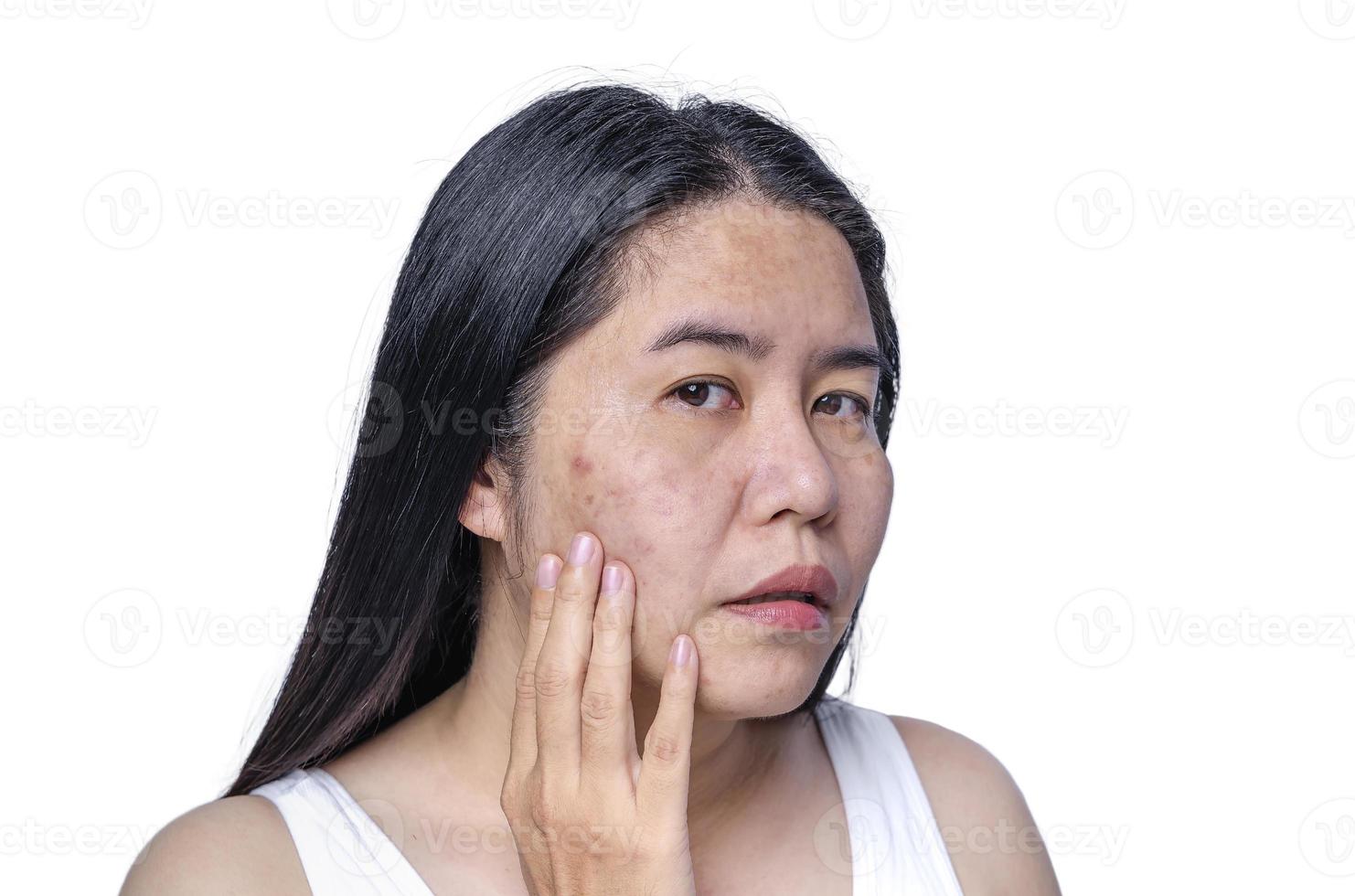 Asian adult woman face has freckles, large pores, blackhead pimple and scars problem from not take care for a long time. Skin problem face isolated white background. Treatment and Skincare concept photo