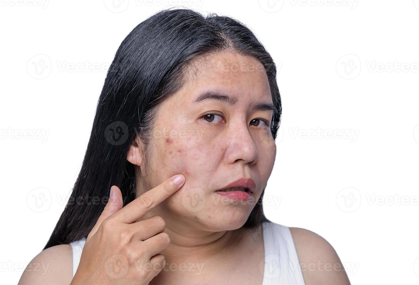 Asian adult woman face has freckles, large pores, blackhead pimple and scars problem from not take care for a long time. Skin problem face isolated white background. Treatment and Skincare concept photo