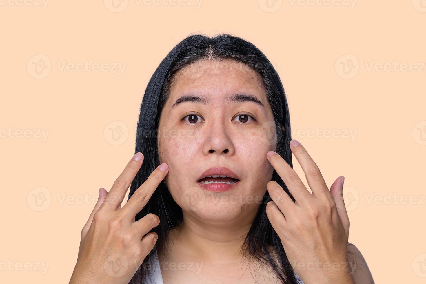 Asian adult woman face has freckles, large pores, blackhead pimple and scars problem from not take care for a long time. Skin problem face isolated yellow background. Treatment and Skincare concept photo