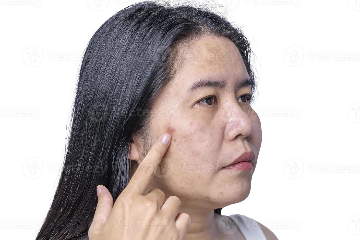 Close up of Asian adult woman face has freckles, large pores, blackhead pimple and scars problem from not take care for a long time. Soft focus of skin problem face. Treatment and Skincare concept photo