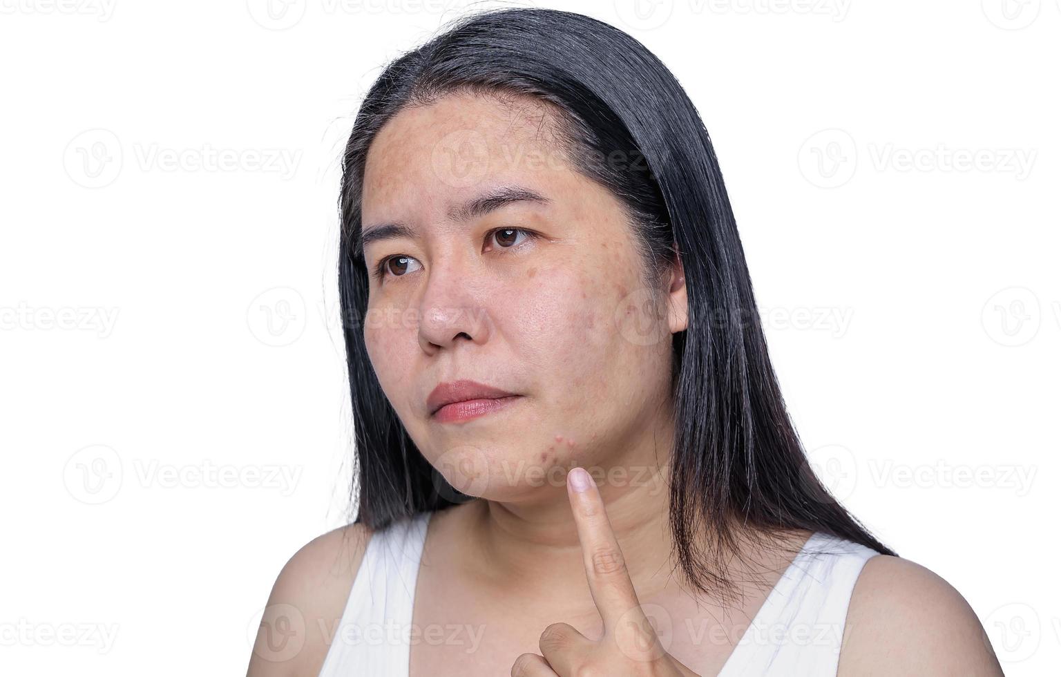 Asian adult woman face has freckles, large pores, blackhead pimple and scars problem from not take care for a long time. Skin problem face isolated white background. Treatment and Skincare concept photo