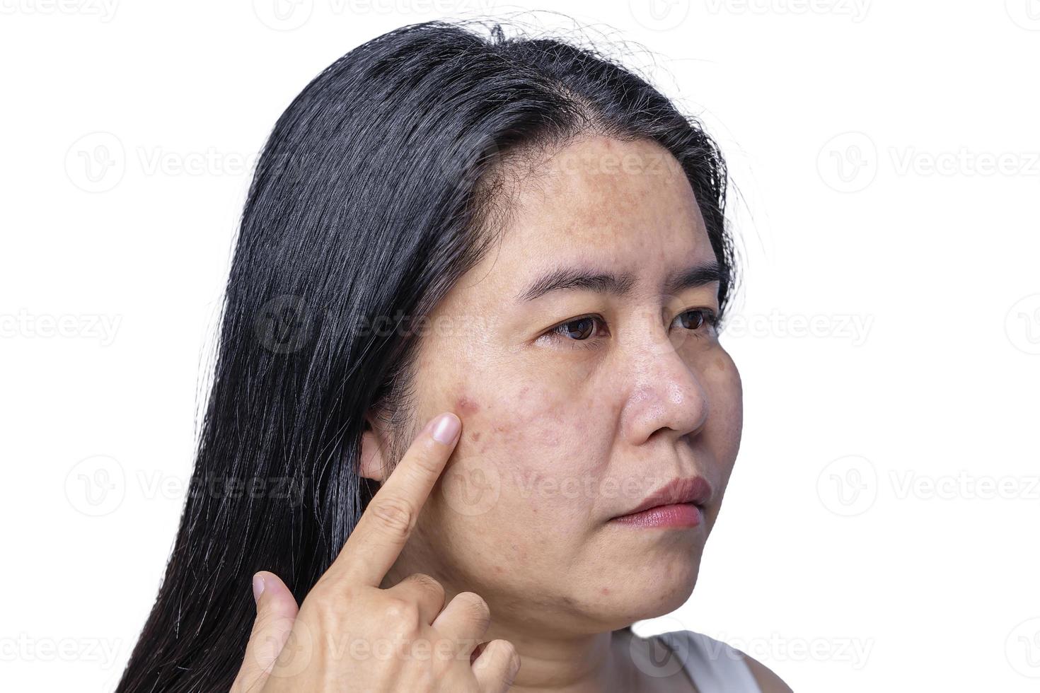 Close up of Asian adult woman face has freckles, large pores, blackhead pimple and scars problem from not take care for a long time. Soft focus of skin problem face. Treatment and Skincare concept photo